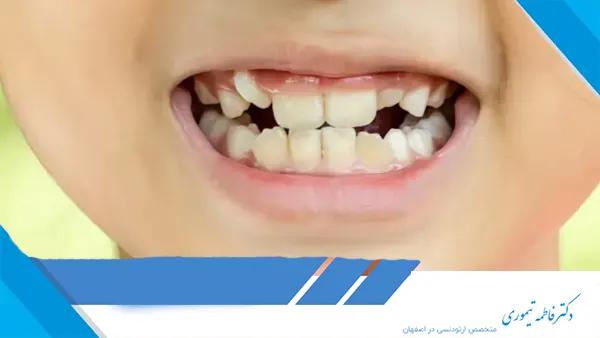 علائم نیاز به ارتودنسی در کودکان چیست؟