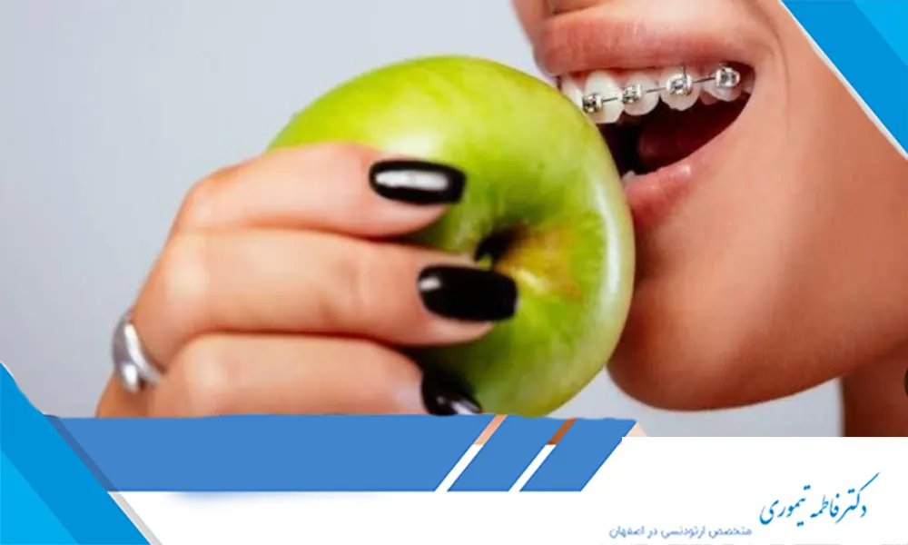 بهترین رژیم غذایی در طول ارتودنسی