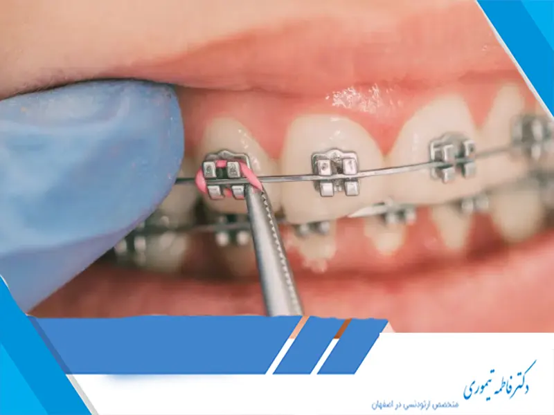 نقش ارتودنسی در بهبود مشکلات تکلم