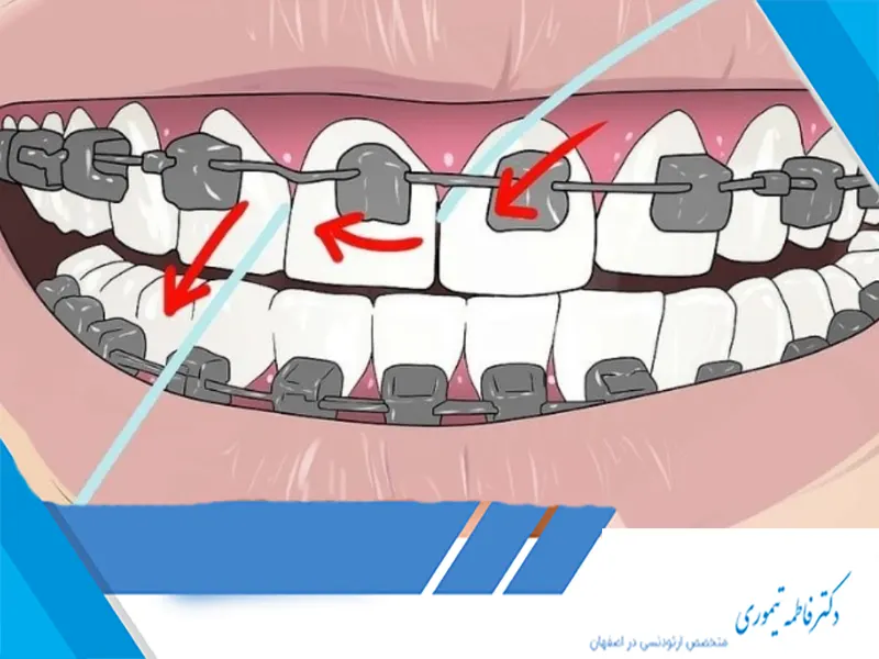 نحوه صحیح نخ دندان کشیدن در زمان ارتودنسی