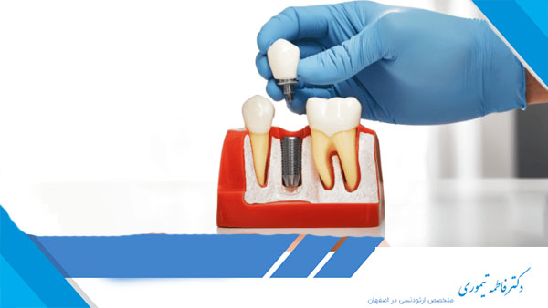چه مدت بعد از کشیدن دندان باید ایمپلنت