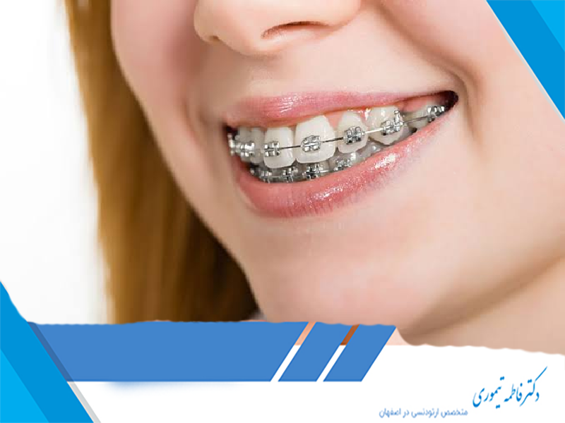 کج شدن دندان‌ها پس از ارتودنسی