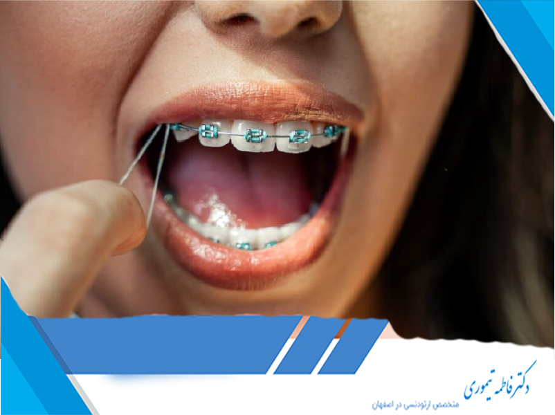 مراقبت‌های پس از برداشتن براکت‌های ارتودنسی