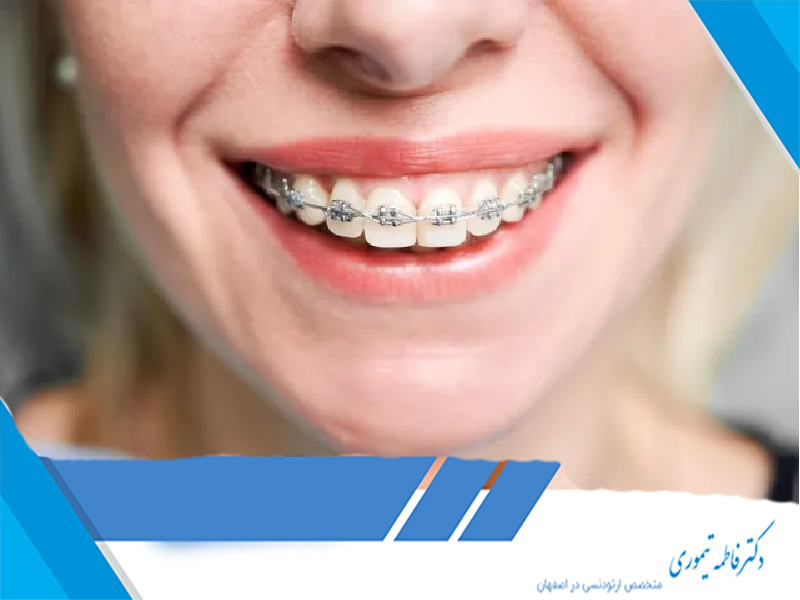 مراقبت‌های پس از برداشتن براکت‌های ارتودنسی