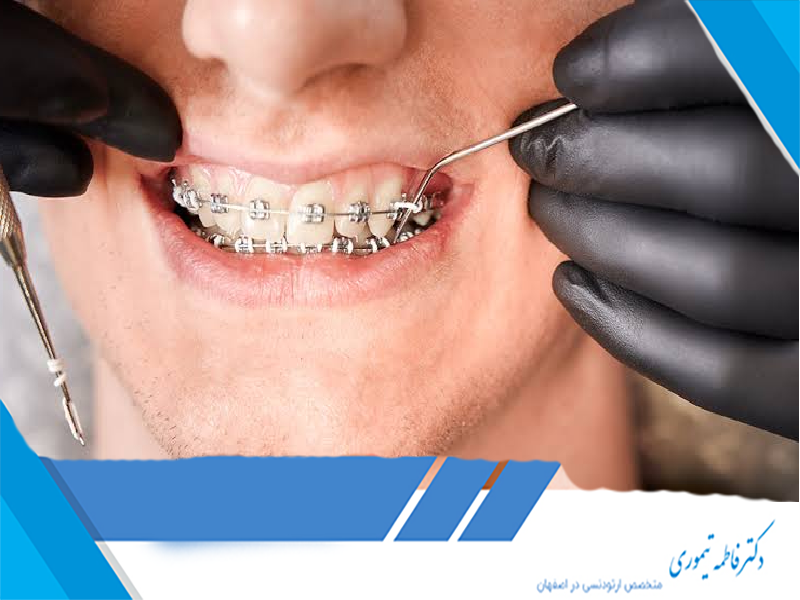 تحلیل ریشه دندان در ارتودنسی