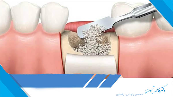 پودر استخوان دندان