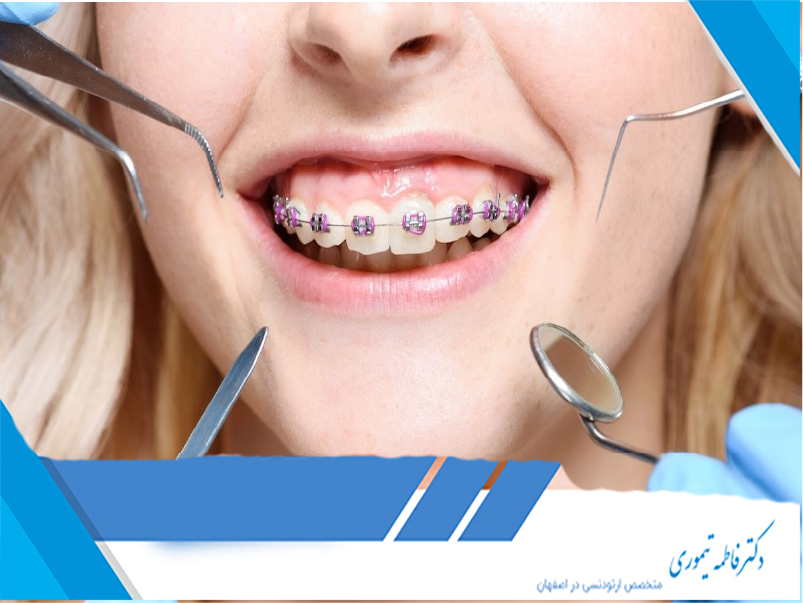 قالب‌گیری دندان‌ها