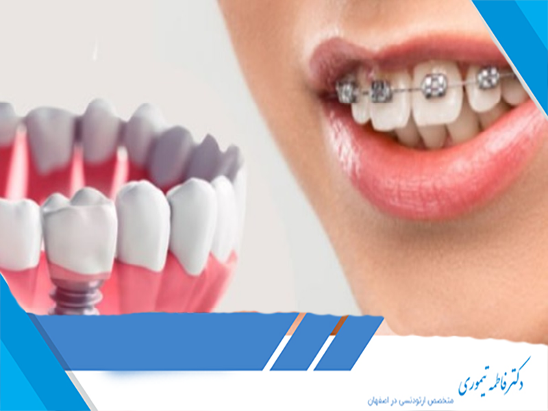  ارتودنسی و ایمپلنت