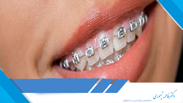 چگونه باید از دندان‌ها و براکت‌ها در طول ارتودنسی مراقبت کرد؟