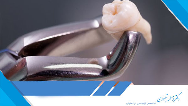 نکات مهم درباره کشیدن ریشه دندان