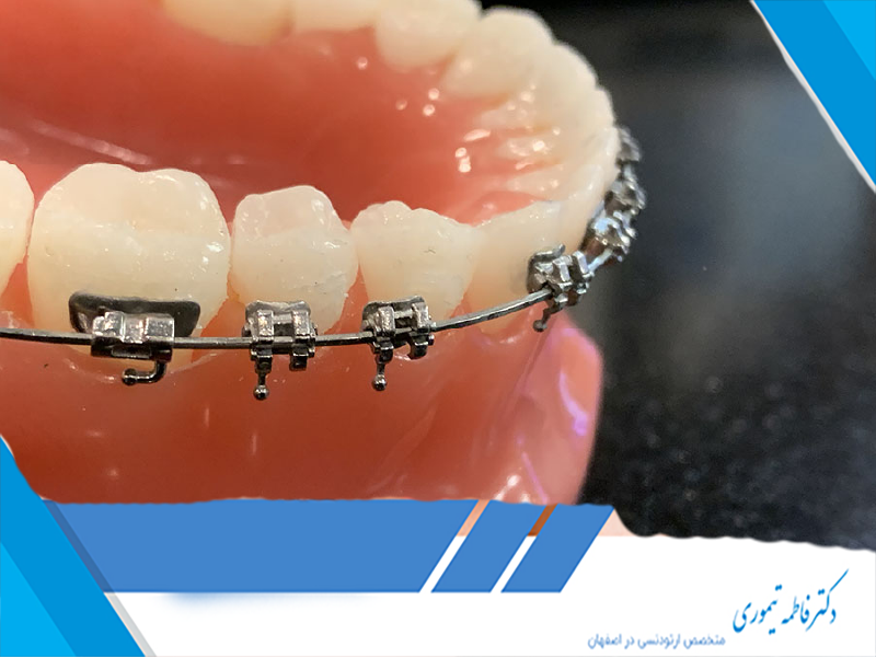 جلوگیری از شکستگی براکت‌های ارتودنسی