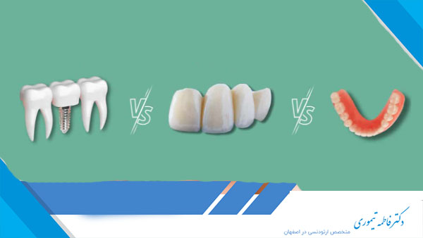 روش‌های کاشت دندان غیر از ایمپلنت