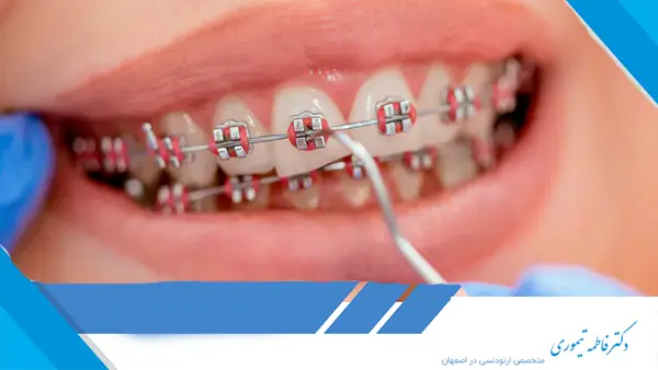 چگونه درد براکت‌ها را کاهش دهیم؟