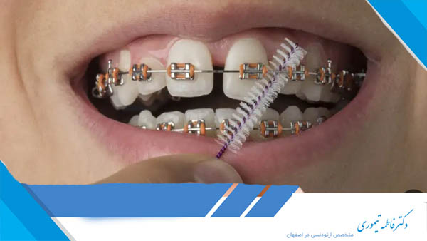 پلاک دندان بعد از ارتودنسی
