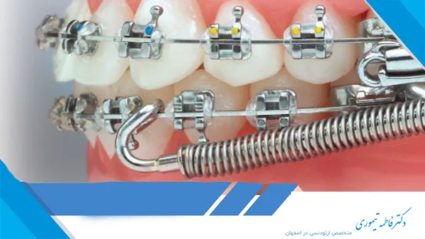 ارتودنسی و بهبود عملکرد جویدن