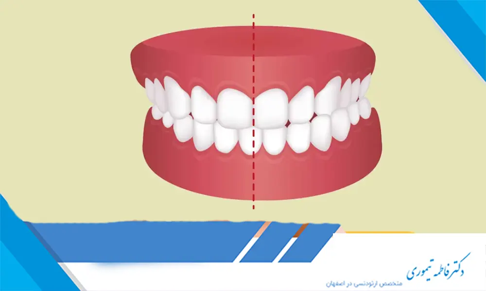 درمان ناهنجاری کراس بایت با ارتودنسی