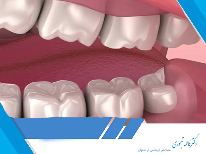 آیا دندان عقل در روند ارتودنسی اختلال ایجاد می‌کند؟