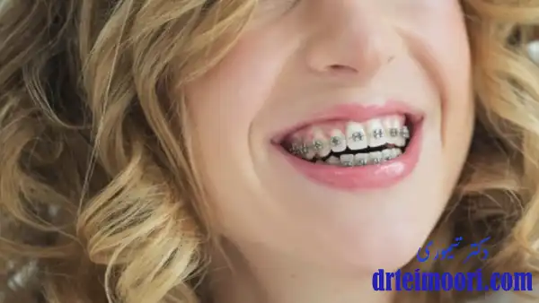 تأثیر ارتودنسی بر بهبود عملکرد بلع​