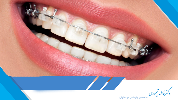 در دوران ارتودنسی چه غذاهایی را نباید خورد؟