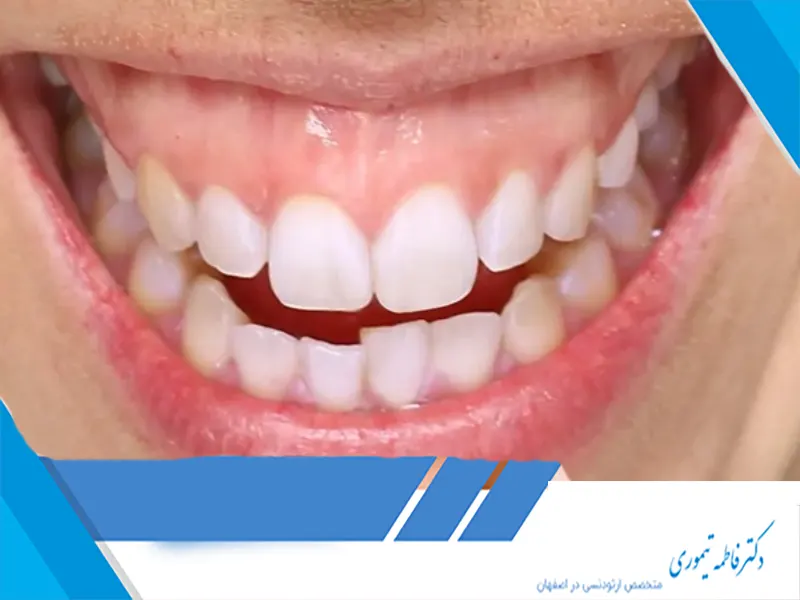 چگونه ارتودنسی می‌تواند به بهبود لبخند لثه‌ای کمک کند؟