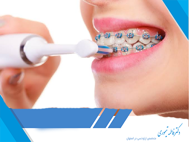 بهترین نوع مسواک برای افرادی که ارتودنسی دارند