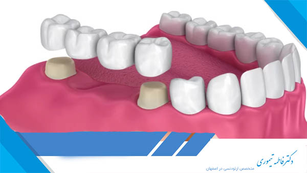 پل دندان چیست