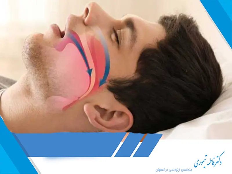 نقش ارتودنسی در درمان آپنه خواب​