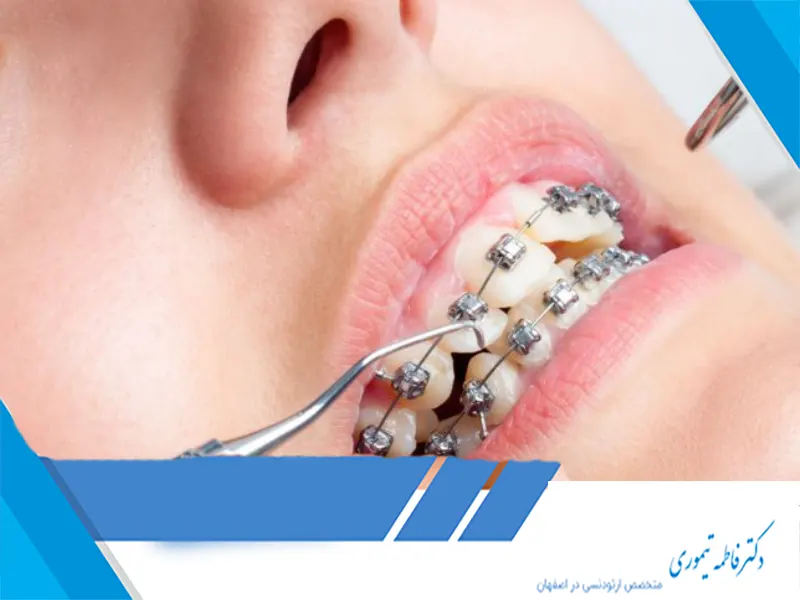 مشکلات ارتودنسی چیست?