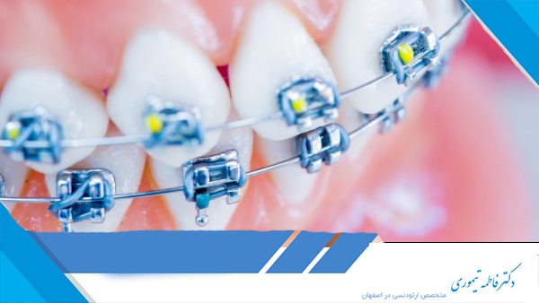 از چه سنی می‌توان ارتودنسی را شروع کرد؟