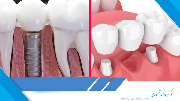 پل دندان بهتر است یا ایمپلنت