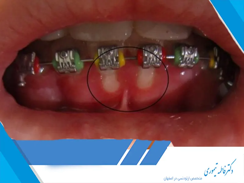 نحوه برخورد با زخم‌های ناشی از سیم ارتودنسی