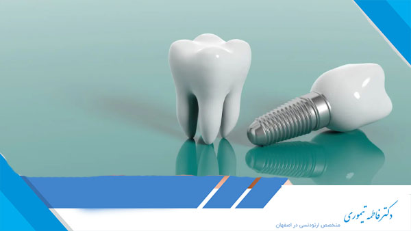 کاشت دندان به روش ایمپلنت