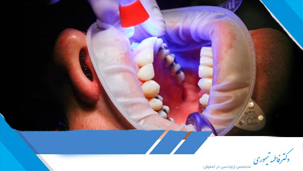 پشیمانی بعد از کامپوزیت دندان