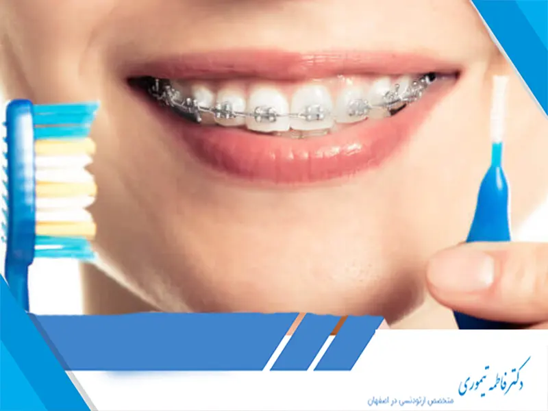 چگونه میتوان از لک شدن دندانها در طول ارتودنسی جلوگیری کرد؟