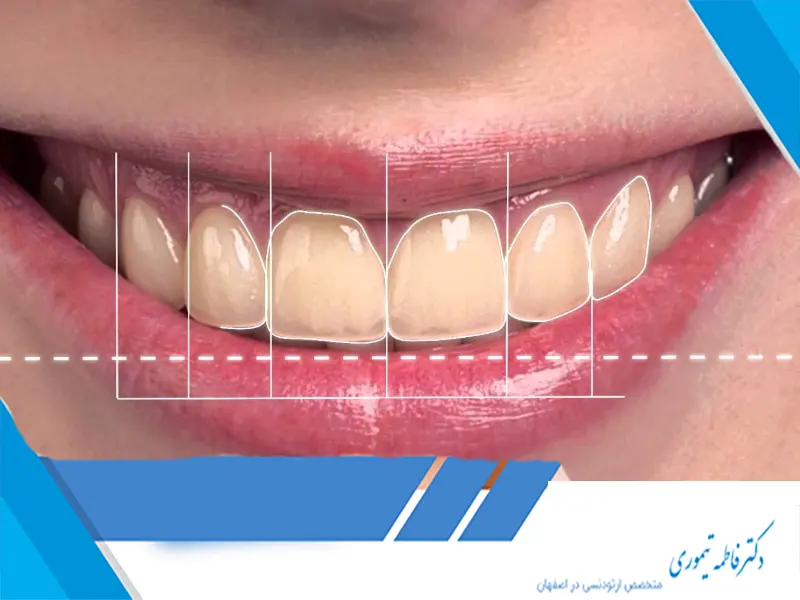 آیا ارتودنسی برای اصلاح خط لبخند مناسب است؟