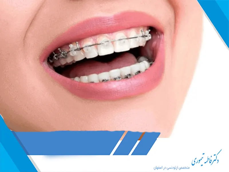 ارتودنسی و بوی بد دهان