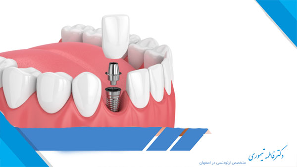 کاشت دندان ایمپلنت چند مرحله دارد