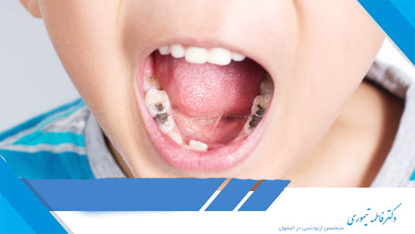 پوسیدگی دندان کودکان