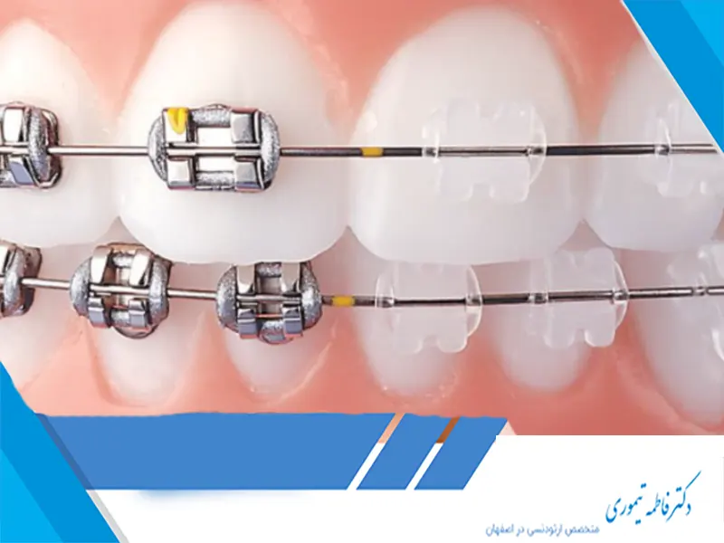 ارتودنسی سریع با روش دیمون