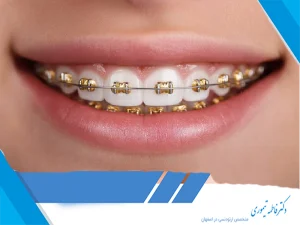 مدت زمان ارتودنسی