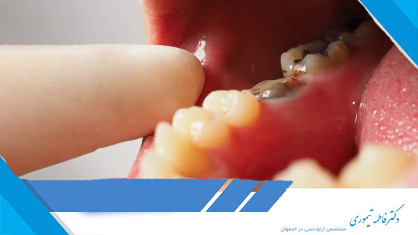 پوسیدگی دندان عقل