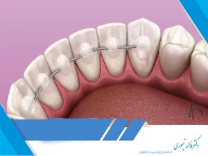 ریتینر بعد از ارتودنسی