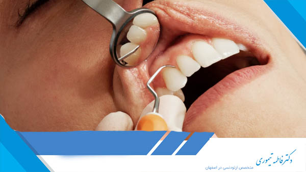 پوسیدگی دندان جلو