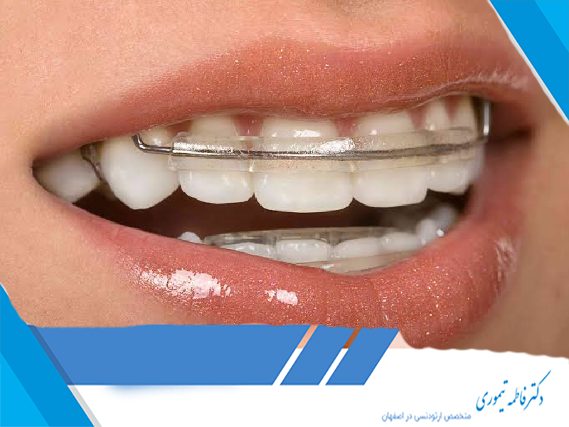ریتینر بعد از ارتودنسی
