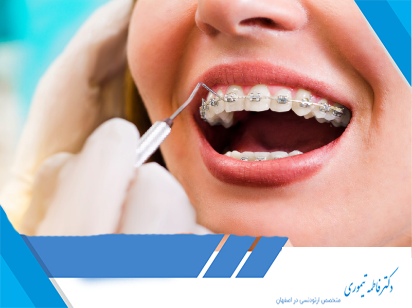 ژل بی‌حس‌کننده برای ارتودنسی