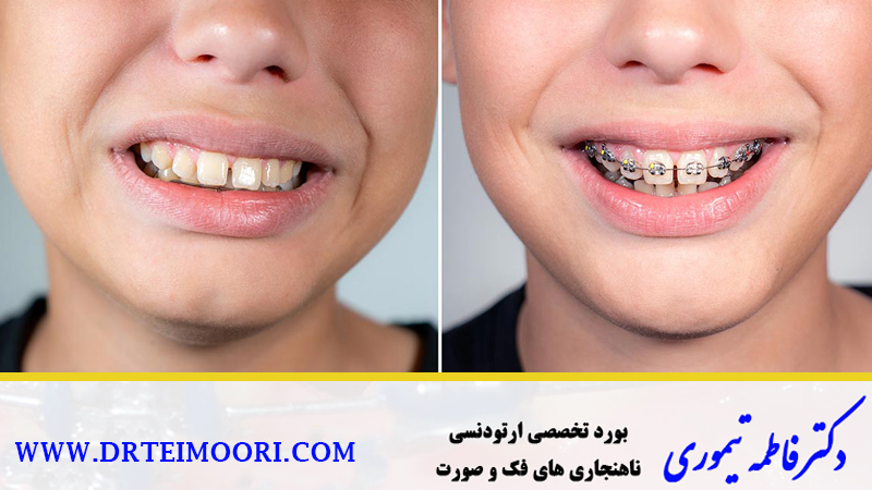 دندانهای تراز شده با ارتودنسی | متخصص ارتودنسی اصفهان
