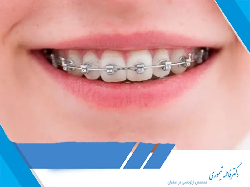 تاثیر ارتودنسی بر فرم لبخند