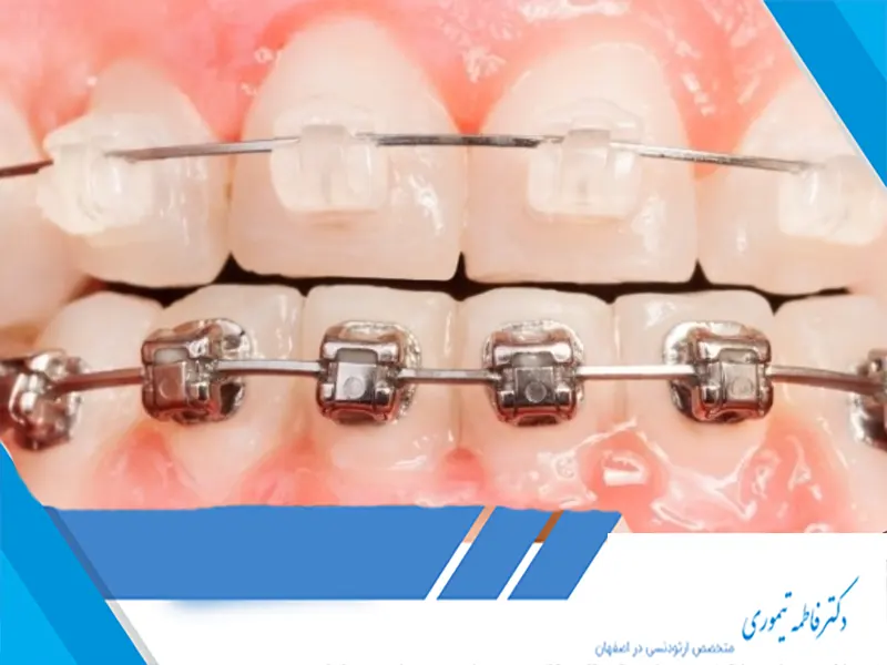تفاوت اساسی بین براکت‌های فلزی و سرامیکی