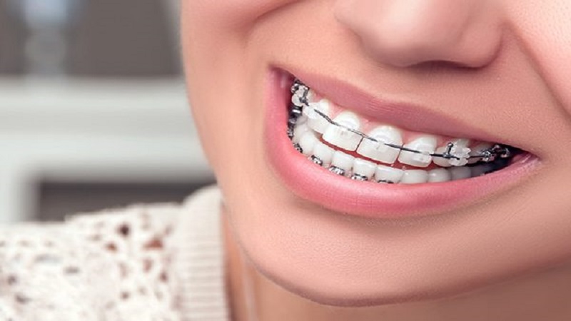 متخصص ارتودنسی اصفهان درمان ناهنجاری دندان نهفته از طریق ارتودنسی