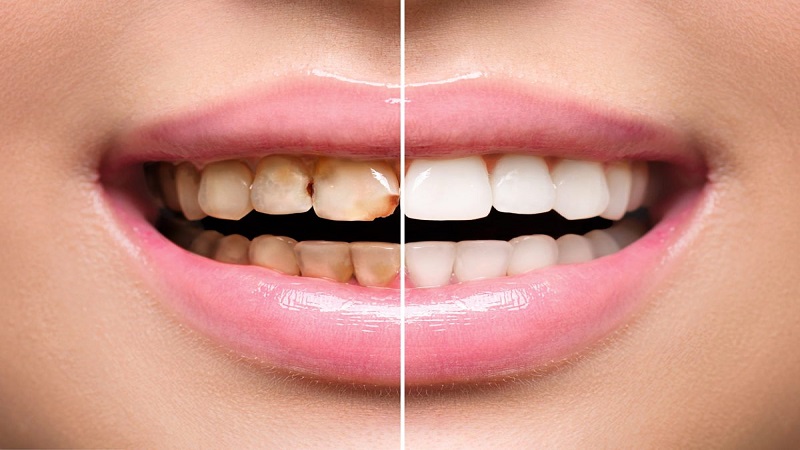 متخصص ارتودنسی اصفهان فرآیند درمان طراحی خط لبخند با ونیر های دندانی